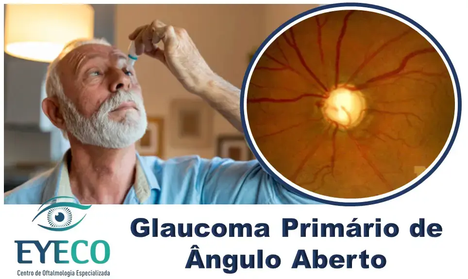 Glaucoma de Ângulo Aberto