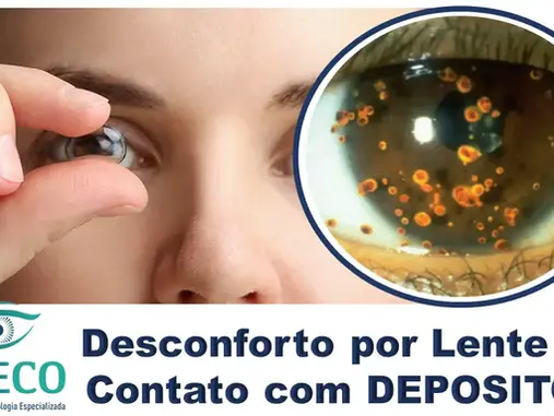 Visão Embaçada e Desconforto? Sua Lentes de Contato Pode Estar Acumulando Depósitos!