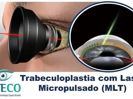Trabeculoplastia com Laser Micropulsado (MLT): Inovação no Tratamento do Glaucoma