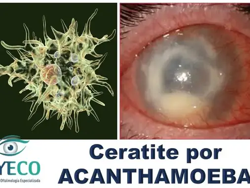Usa Lente de Contato e tem Dor Ocular Intensa? Pode Ser Ceratite por Acanthamoeba – Descubra Como Evitar!
