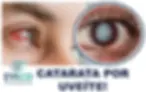 Catarata por Uveíte