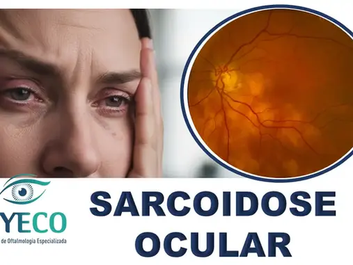 Sarcoidose Ocular: Diagnóstico, Sintomas e Tratamento Baseado em Evidências