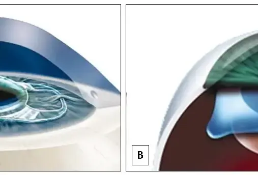 Lentes Intraoculares Fácicas: Tecnologia de Ponta para Corrigir Miopia, Hipermetropia e Astigmatismo