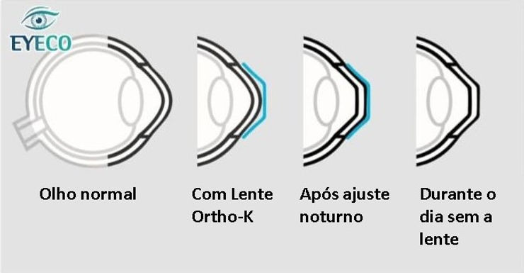 Correção da miopia com Ortoceratologia (Ortho-K).