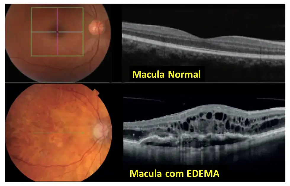 Tomografia de Coerência Óptica (OCT) de Retina comparando entre Retina Normal e com Edema Macular Diabético