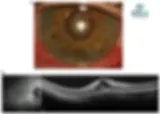 Foto do segmento anterior evidenciando inflamação ocular grave. (a) Aderências na íris (sinequias posterior) e depósito de fibrina. (b) Exame de OCT mostra acúmulo de líquido na mácula (edema macular).