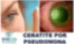 Ceratite por Pseudomona apos uso de Lentes de Contato