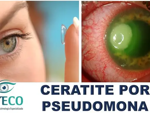 Lentes de Contato Podem Causar Infecção Grave! Saiba Como se Proteger da Ceratite por Pseudomona