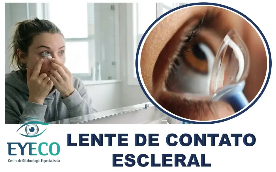 Lentes de Contato Esclerais: Solução de Correção Visual para Casos Desafiadores