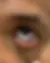 Melanocitose Oculodermal