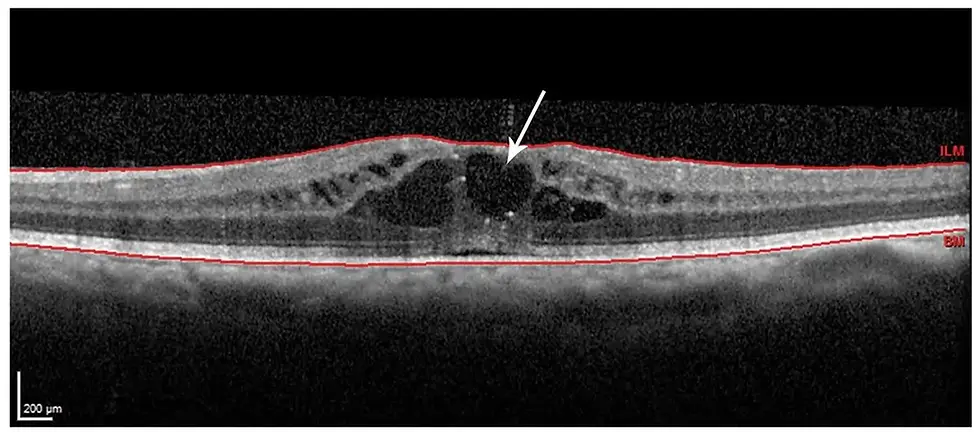 A OCT revela edema macular cistoide após cirurgia de catarata, com líquido na mácula, causando visão embaçada.