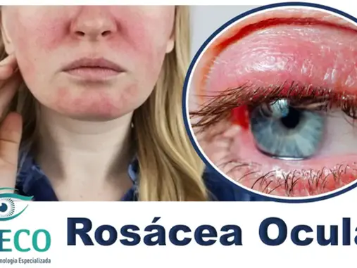  Rosácea Ocular e Blefarite
