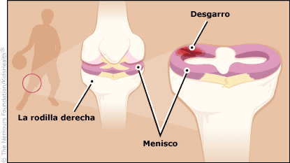 meniscusTear-415x233-esIL.gif