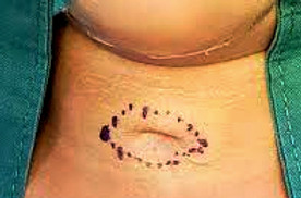 Fístula Traqueocutânea