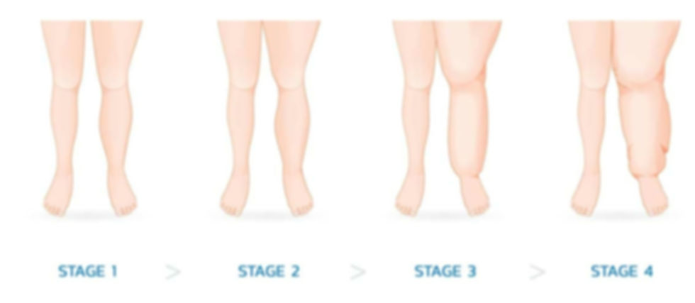 stages-lymphedema-2-1030x549_edited.jpg