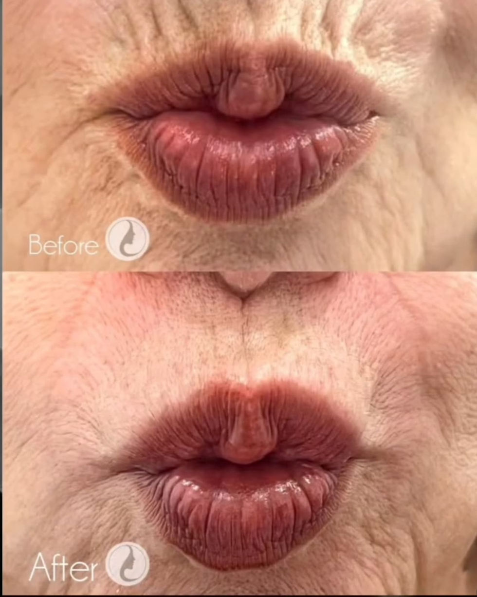 Somker's line filler