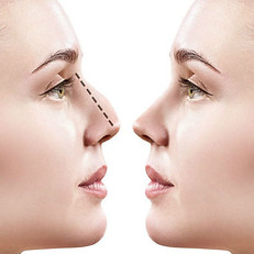 rinoplastia.jpg