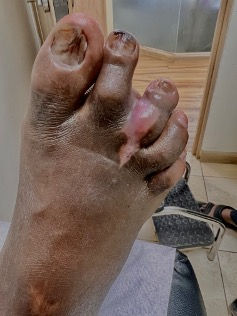 A picture of a diabetic foot wound After treatment by Diabetes Specialist in Nairobi Dr. E