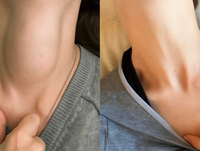 Thyroid Nodule radio frequency ablation therapy in Kenya is the best alternative to thyroi