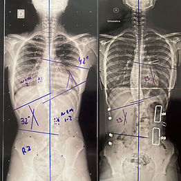 COLETE 3D / ESCOLIOSE BRASIL / COLETE S4D