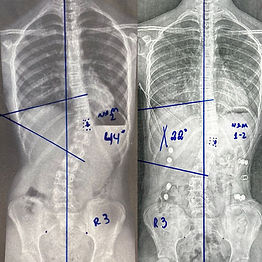 COLETE 3D / ESCOLIOSE BRASIL / COLETE S4D