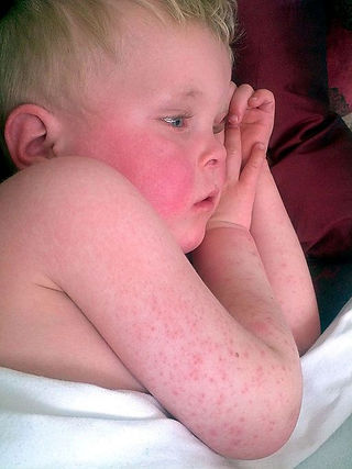 Scarlet Fever | www.badobadop.co.uk, CC BY-SA 3.0, via Wikimedia Commons