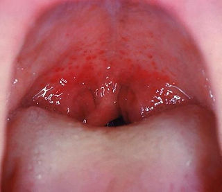 Streptococcal pharyngitis | CDC/Dr. Heinz F. Eichenwald, Public domain, via Wikimedia Commons