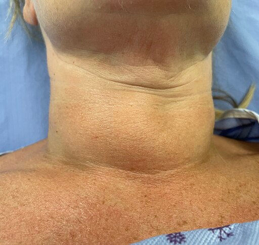 Close-up of a goiter.