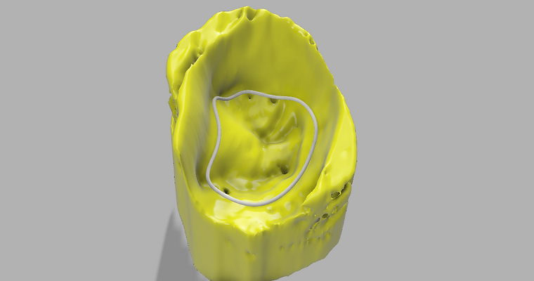Mitral Valve Image Reconstruction v2.png