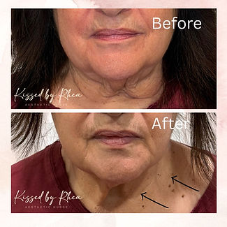 Nefertiti Lift Before & After .JPG