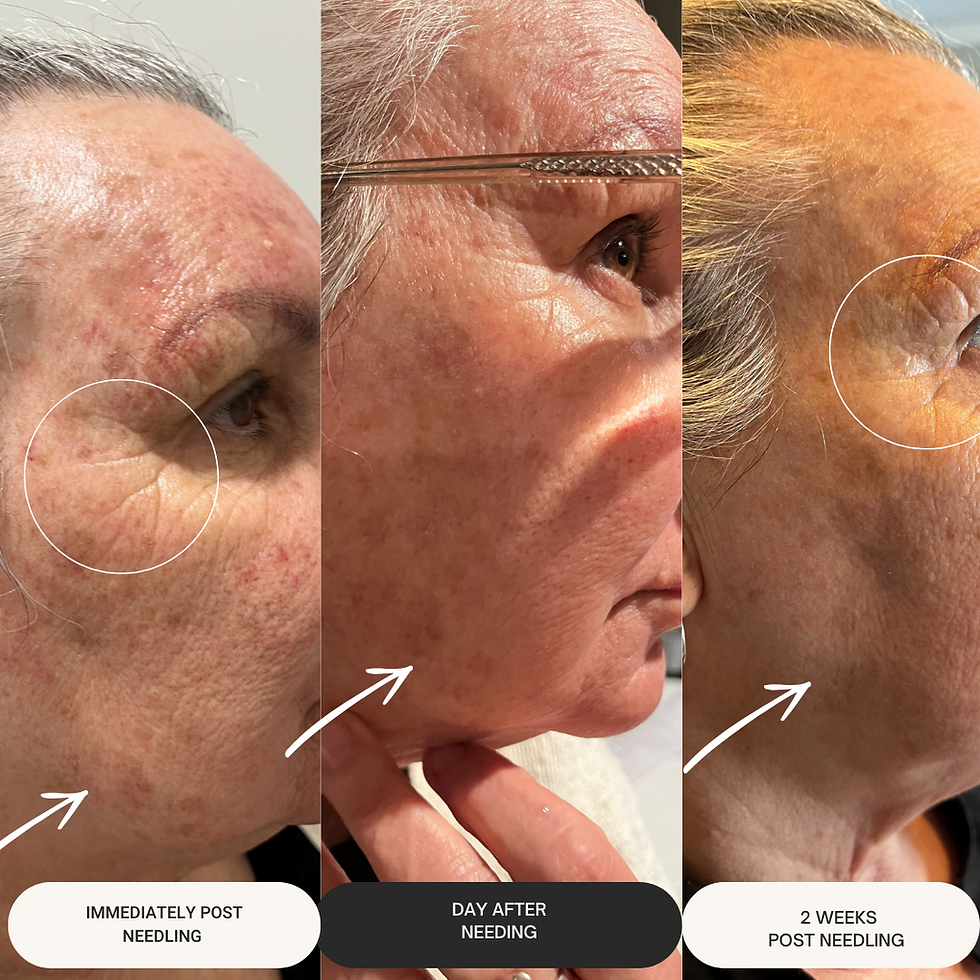 Thumbnail: Environ Dermaroller Microneedling