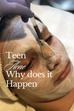 Effective Acne Solutions for Teens: Your Path to Clear Skin
