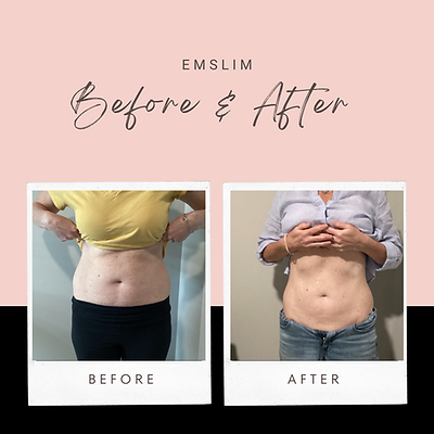 6 - EmSlim Body Tightening Treatments SAVE $195