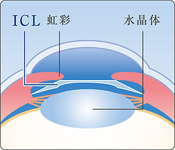 ゆきた眼科 ICL