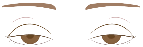 【6】眼瞼下垂 両目.png
