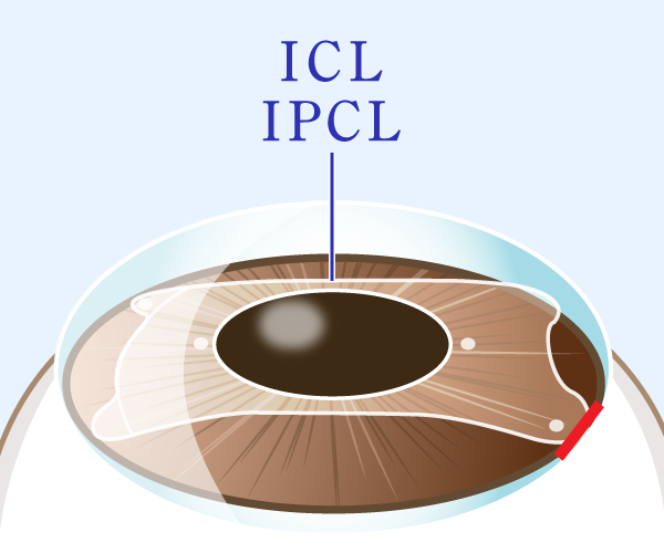 ゆきた眼科様_ICLIPCL2.png