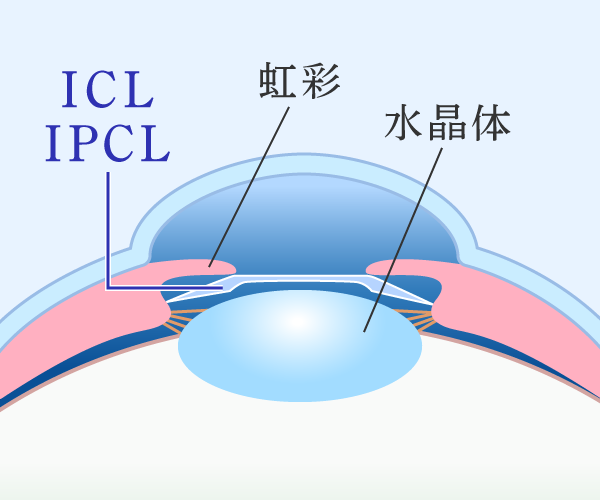 ICL・IPCL（有水晶体眼内レンズ）手術 | ゆきた眼科 まぶたと眼の