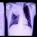 Tumor de mediastino