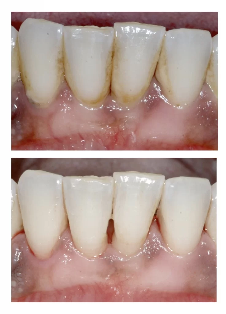 Periodontal Disease.webp