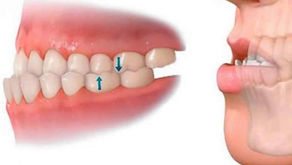¿POR QUÉ LOS DIENTES TORCIDOS TE PUEDEN CAUSAR PROBLEMAS?