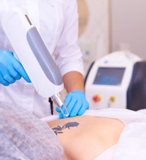 tattoo removal.jpg