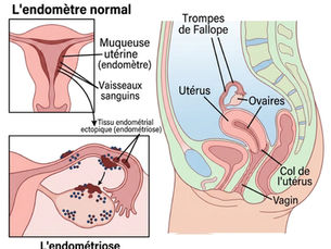 Ostéopathie et endométriose