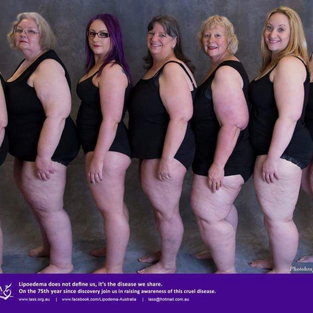 What is Lipedema ?