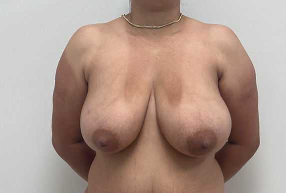 Breast reduction before and after results in White Plains NY for improved comfort and proportion