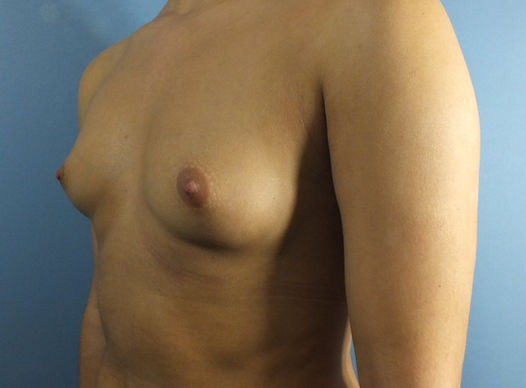 Breast augmentation before and after results in White Plains NY with natural looking enhancement
