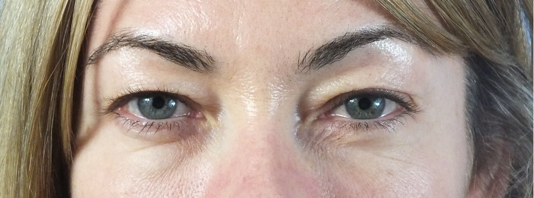 Eyelid surgery before and after results in White Plains NY improving drooping eyelids