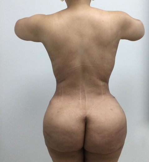 Brazilian butt lift surgery in White Plains NY for enhanced natural curves