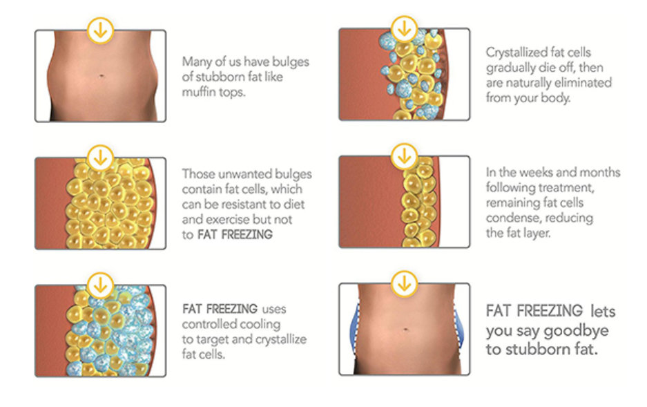 Fat Freezing.jpeg
