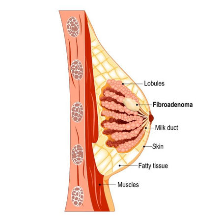 Nodulii la sân: Tot ce trebuie să știi despre fibroadenoame și mastoza fibrochistică