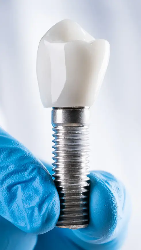 implant dentar clinica stomatologica pentek dent timisoara.webp